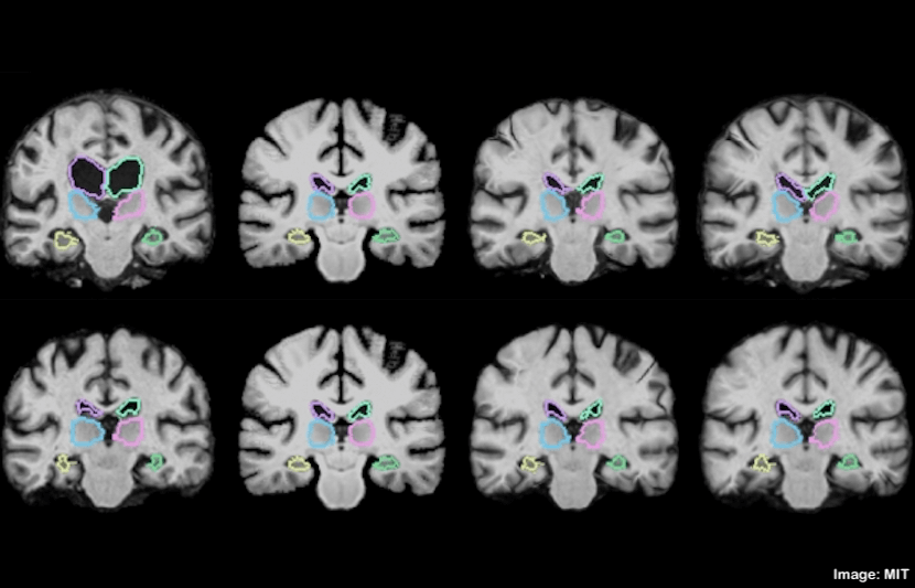 New Algorithm Makes Analyzing Brain Scans 1,000 Times Faster